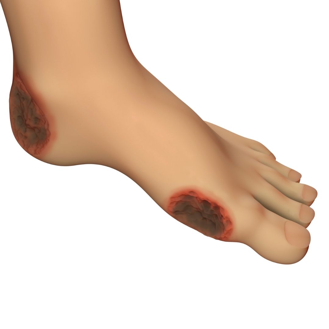 Dijabetički ulkus / rana na stopalima