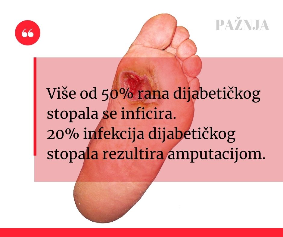 brže zacjeljivanje dijabetičnih rana